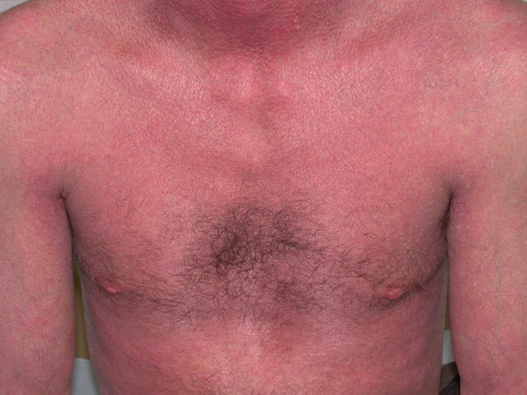 Eczema On Chest Pictures Photos