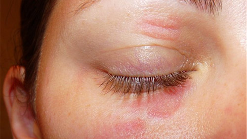 What Causes Eyelid Dermatitis