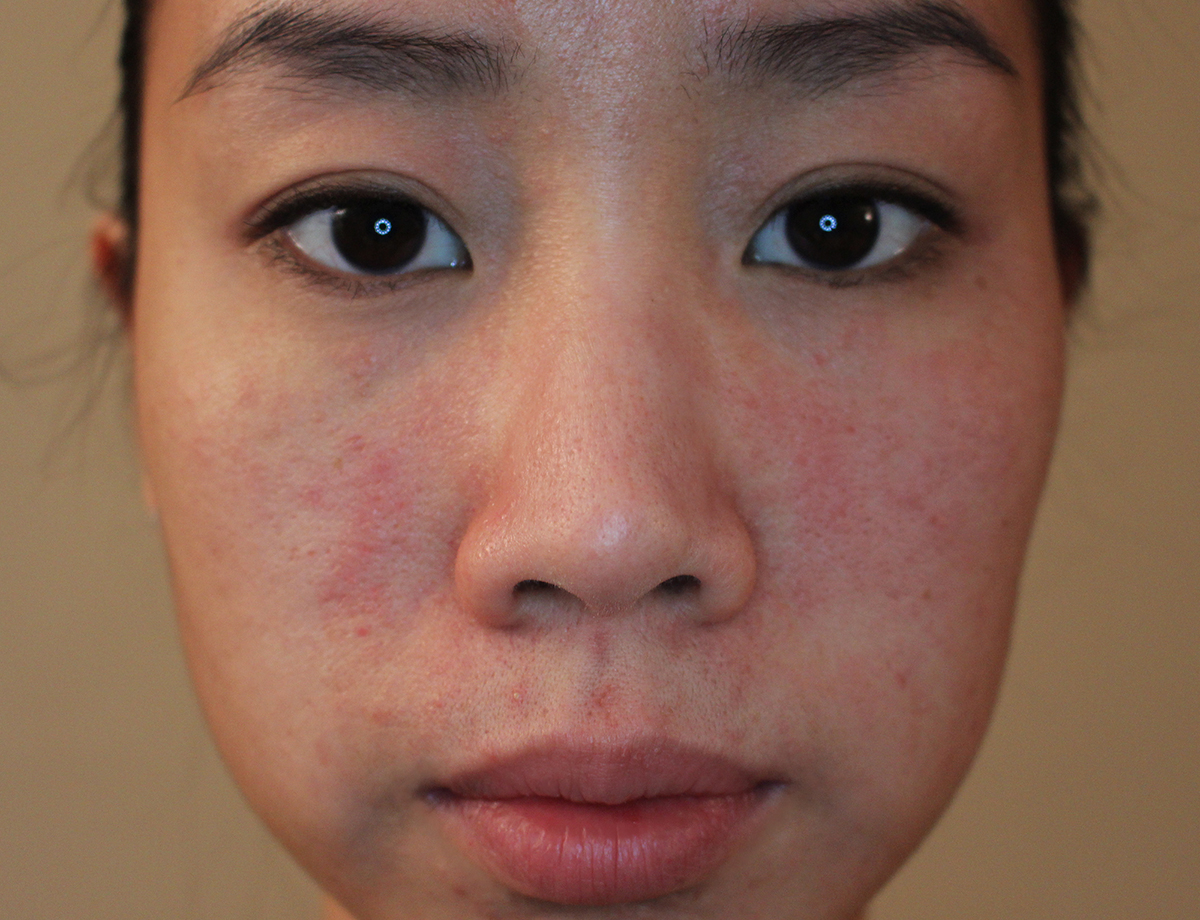 allergic reaction face - pictures, photos
 Makeup Allergic Reaction