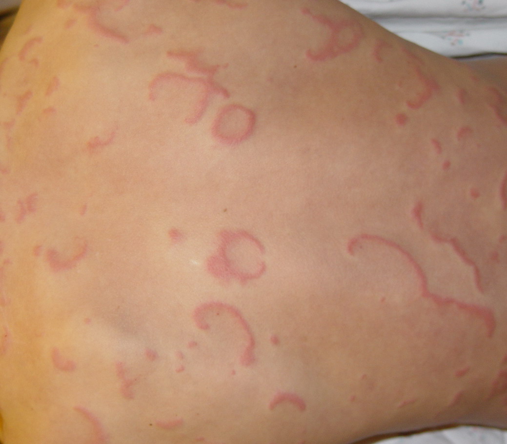 Annular Erythema Pictures Photos