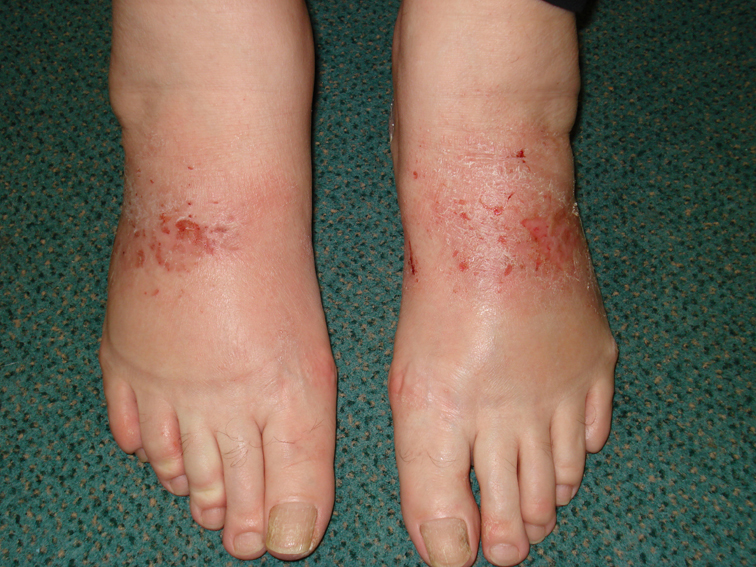 What does dermatitis look like on feet