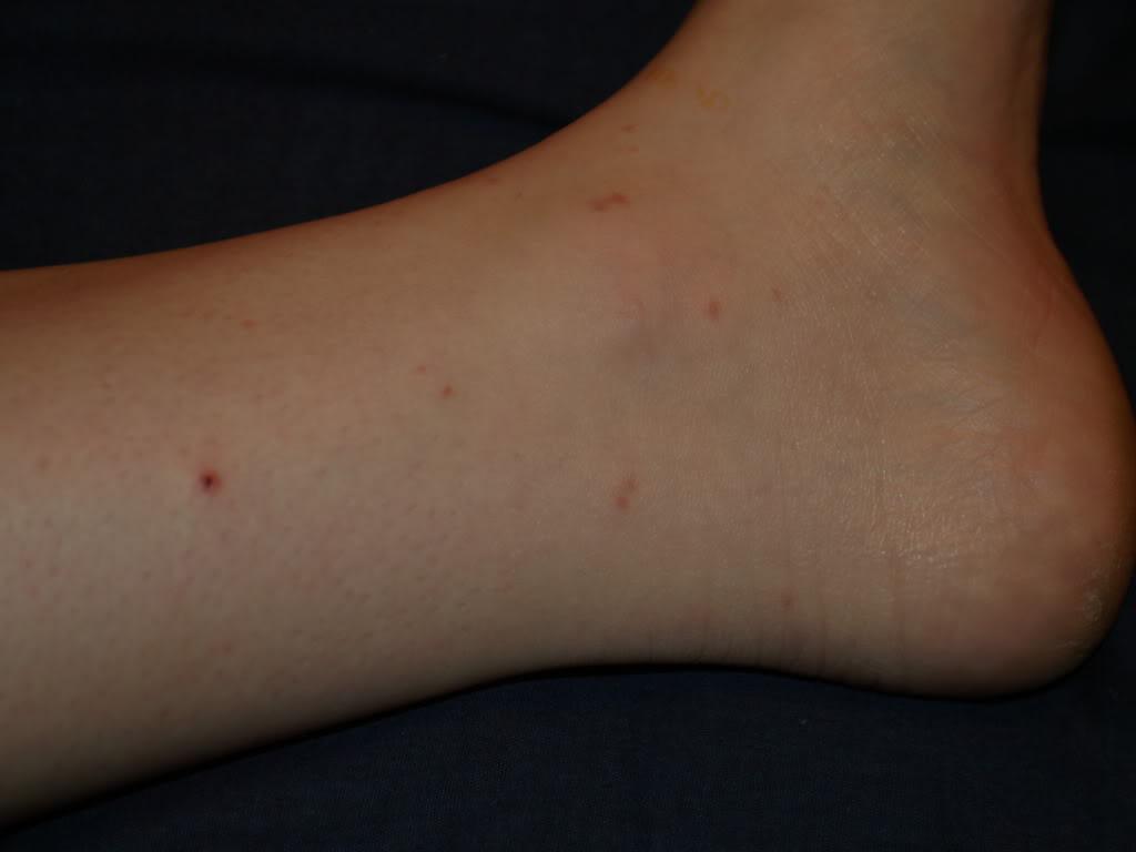 flea bites ankles - pictures, photos