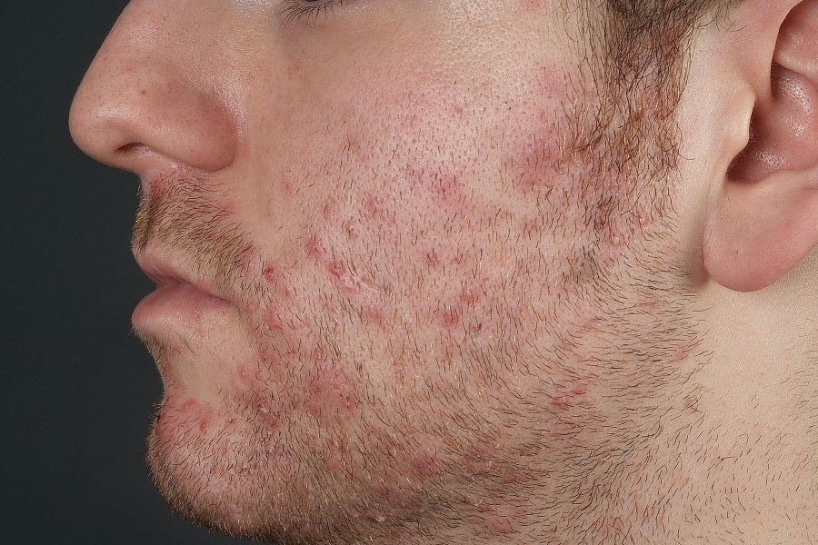 folliculitis from shaving pictures, photos