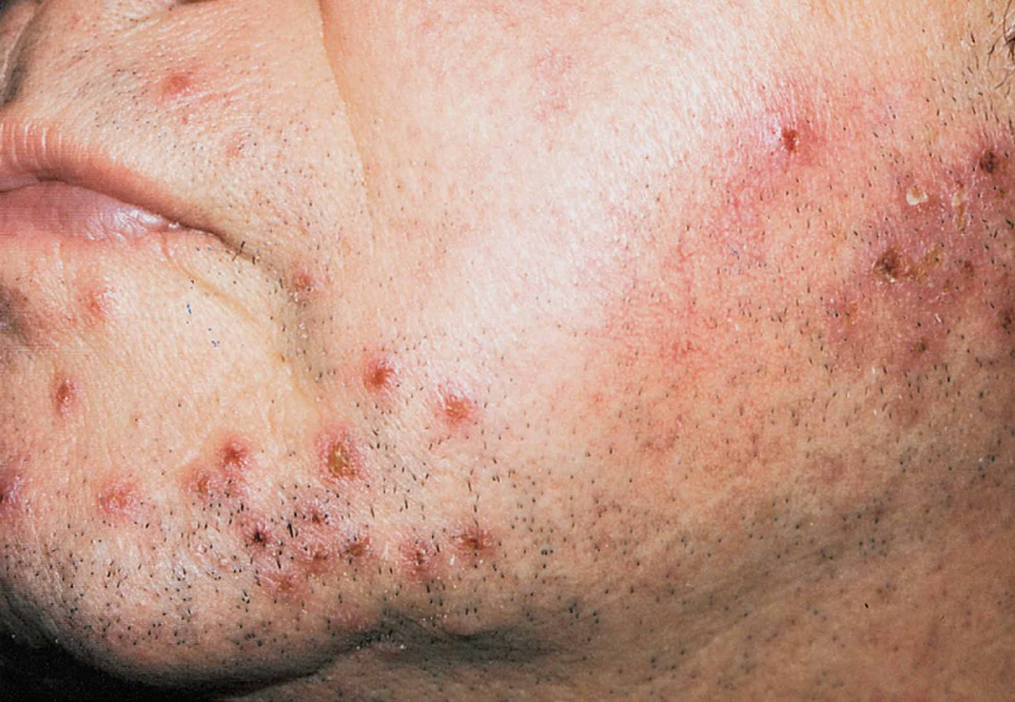 folliculitis bumps pictures, photos