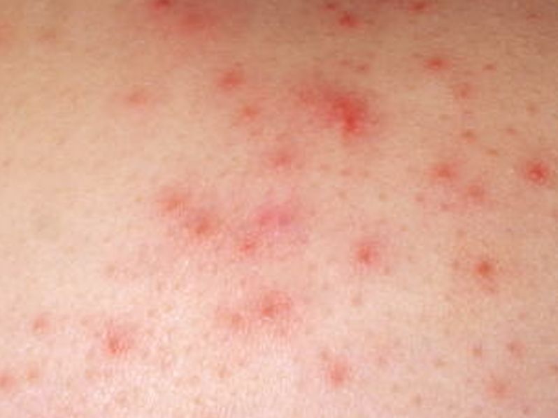 deep folliculitis - pictures, photos