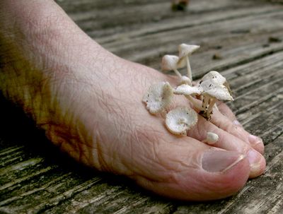 Foot Fungus Types - Toe Fungus - Treatment, Symptoms & Causes / Foot