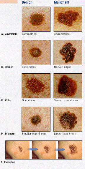 Freckles Vs Moles Pictures Photos