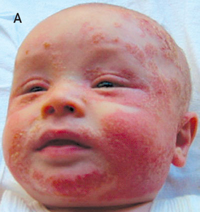 dermatitis babies - pictures, photos