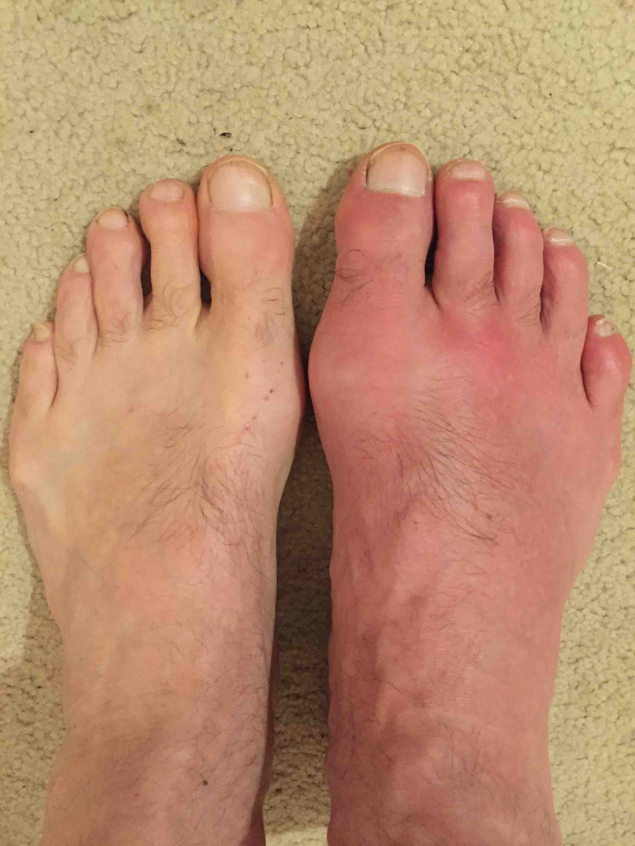 images of gout - pictures, photos