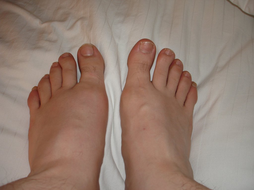 Pictures Of Gout In Feet Pictures Photos 1844