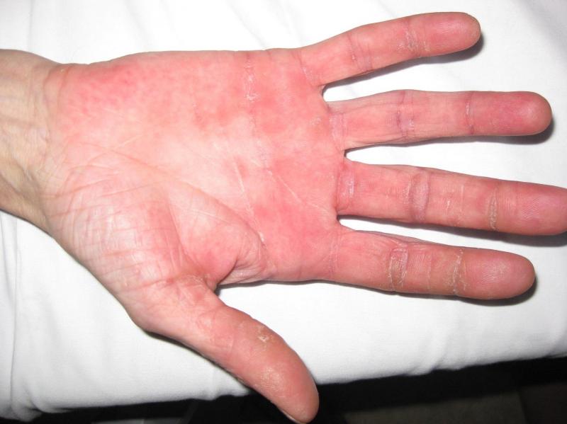 What disease causes itchy hands and feet