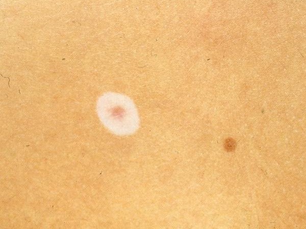 halo-nevus-pictures-photos