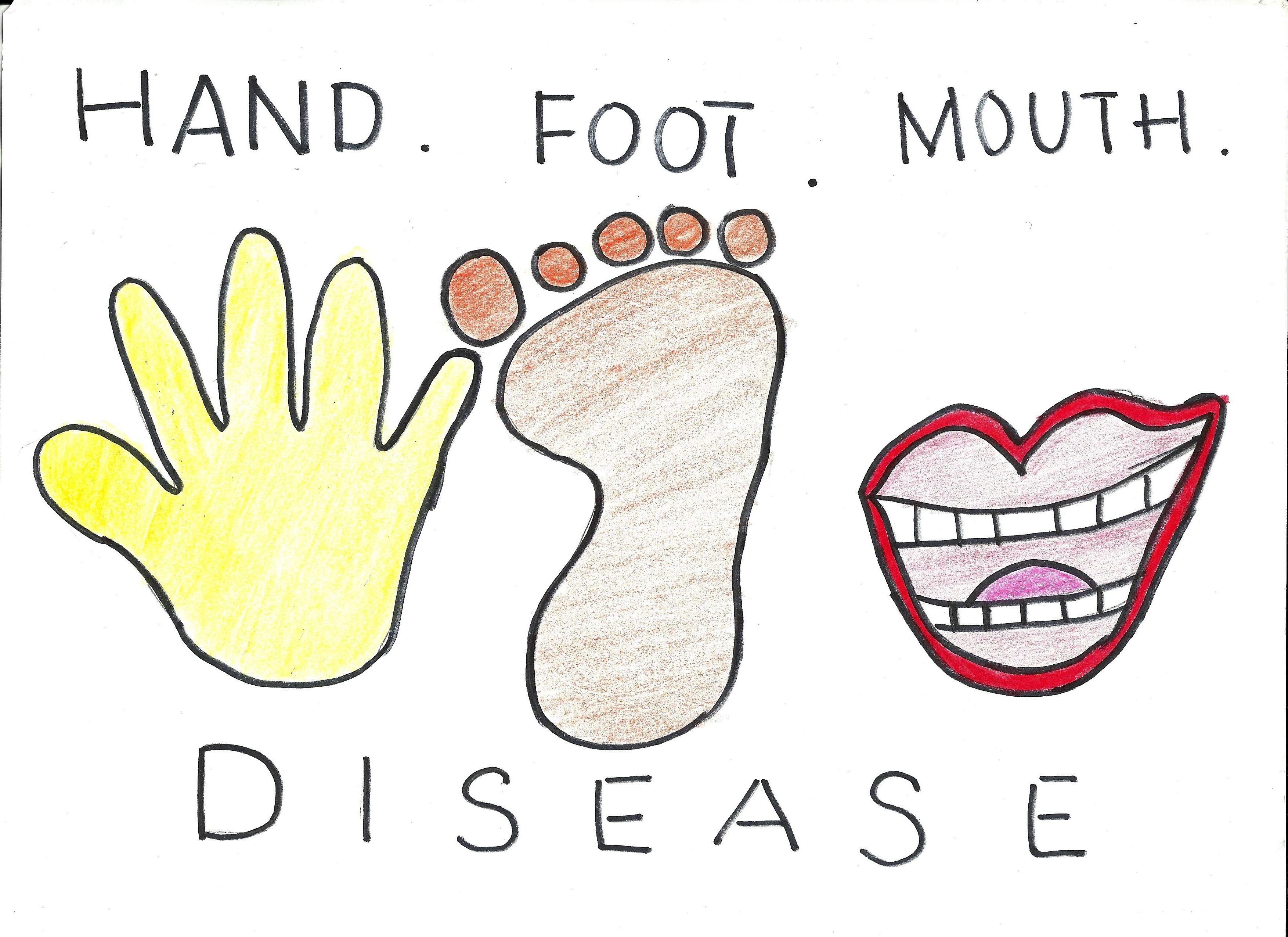 Amazing Essential Oil Uses For Hand Foot Mouth Sufferers - q6pblk9