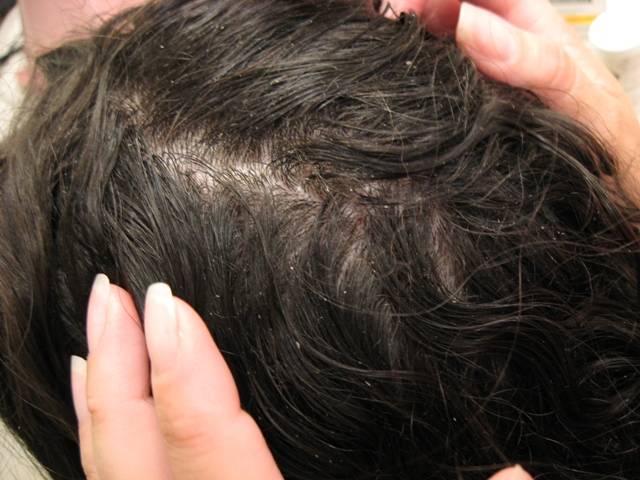 Head Lice In Adults Pictures Photos