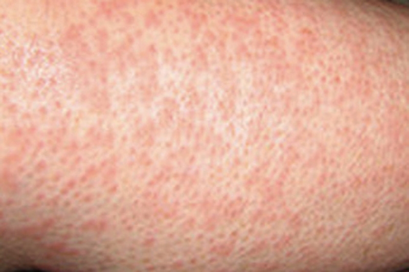 Heat Rash Pictures, Symptoms, Causes, & Treatments