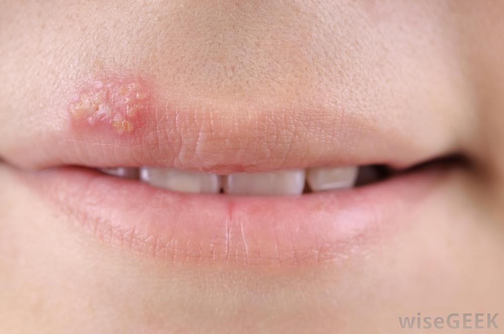 clear-blister-on-inside-of-lip-pictures-photos