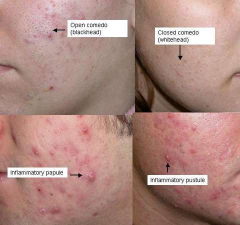 light herpes breakout