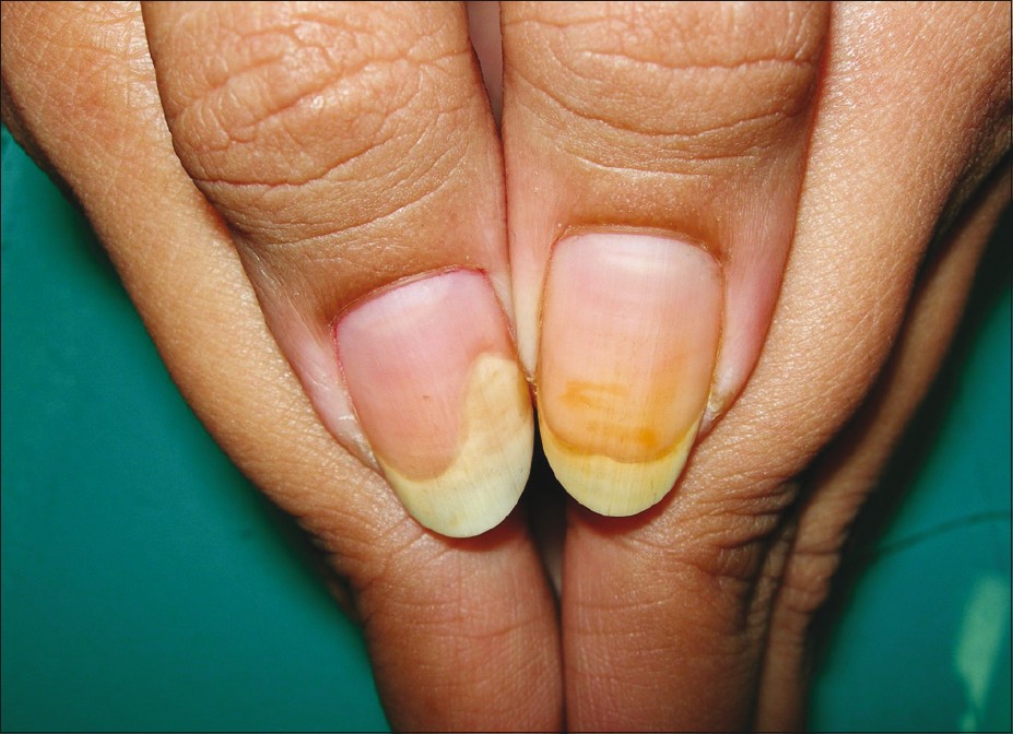acrylic allergy pictures, photos