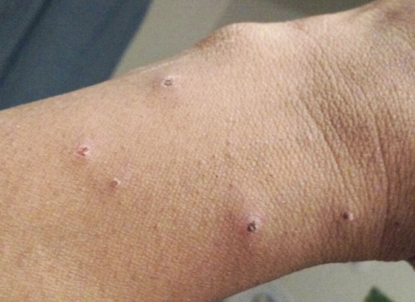 bed bug bite pictures