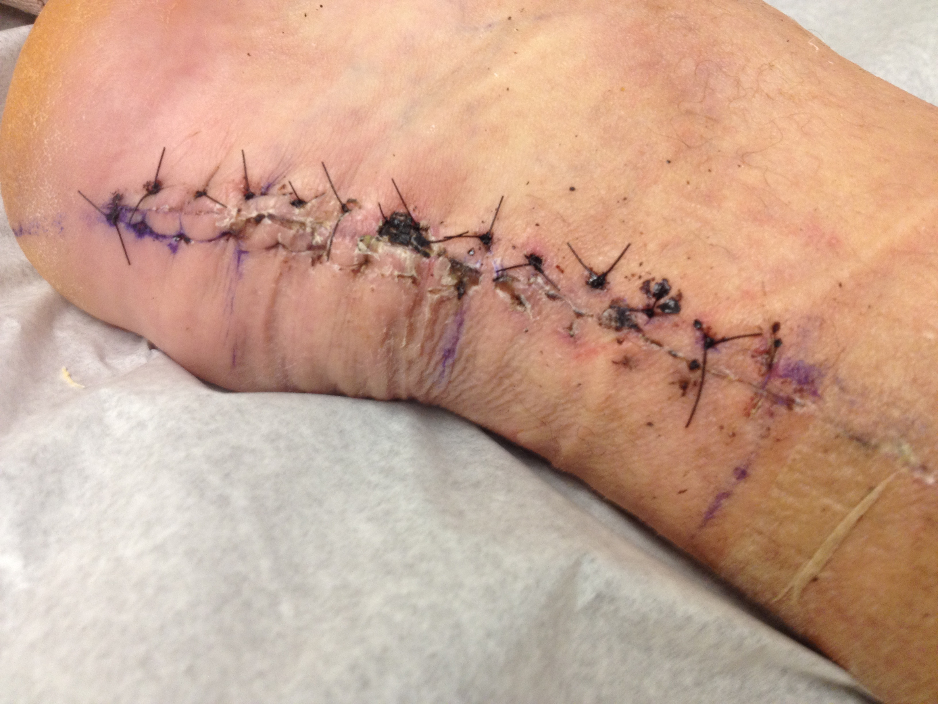 pictures of stitches - pictures, photos