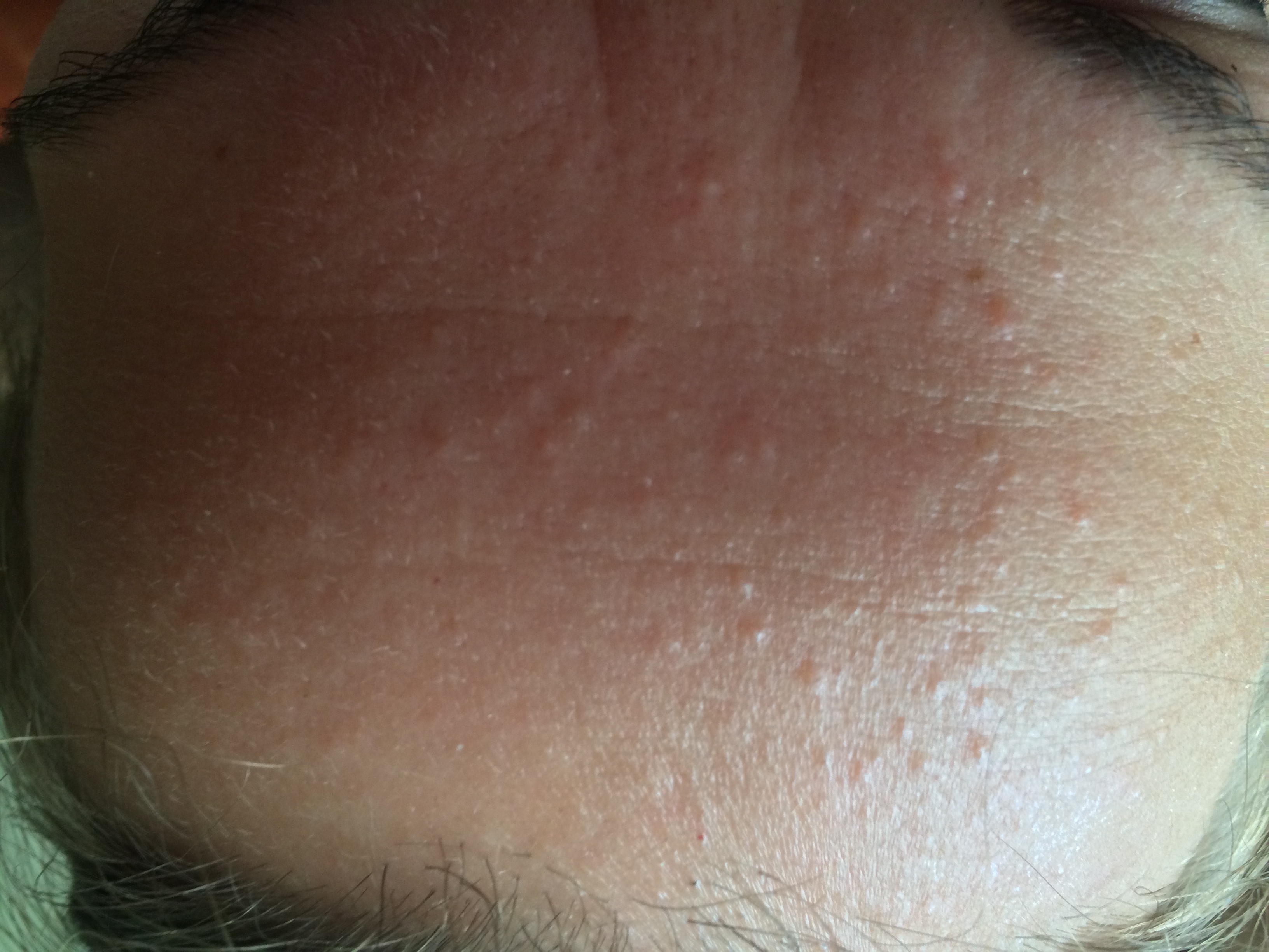 Raised Red Bumps On Skin Pictures Photos 