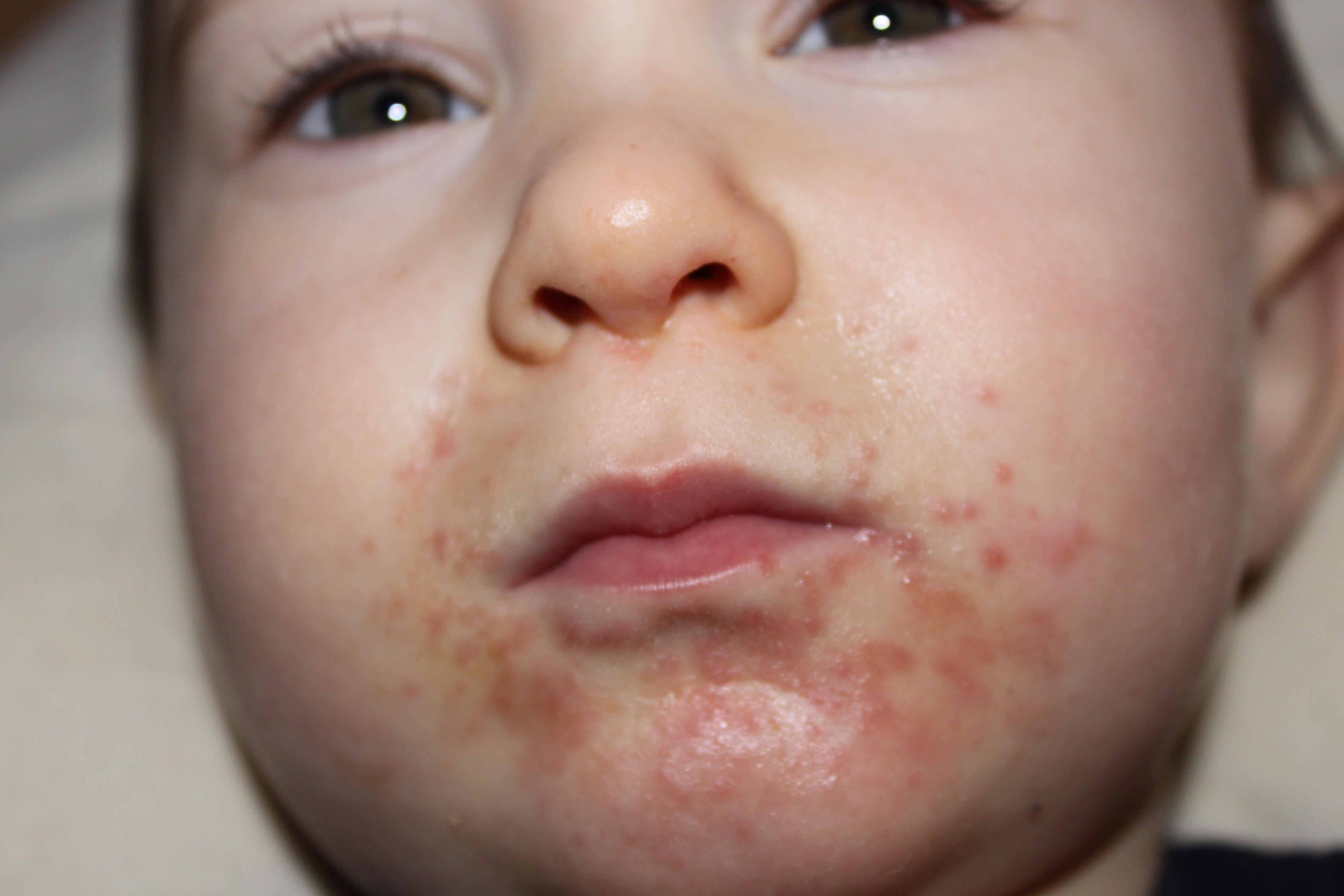 childrens rash around mouth pictures, photos
