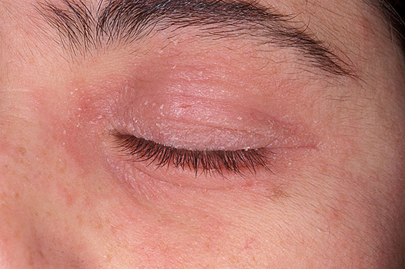 eye-rashes-on-eyelids-pictures-photos