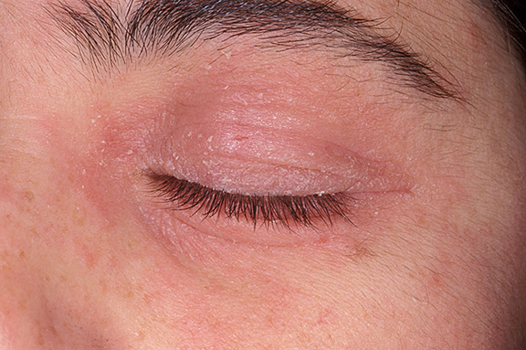 Dermatitis On Eyelid Pictures Photos 