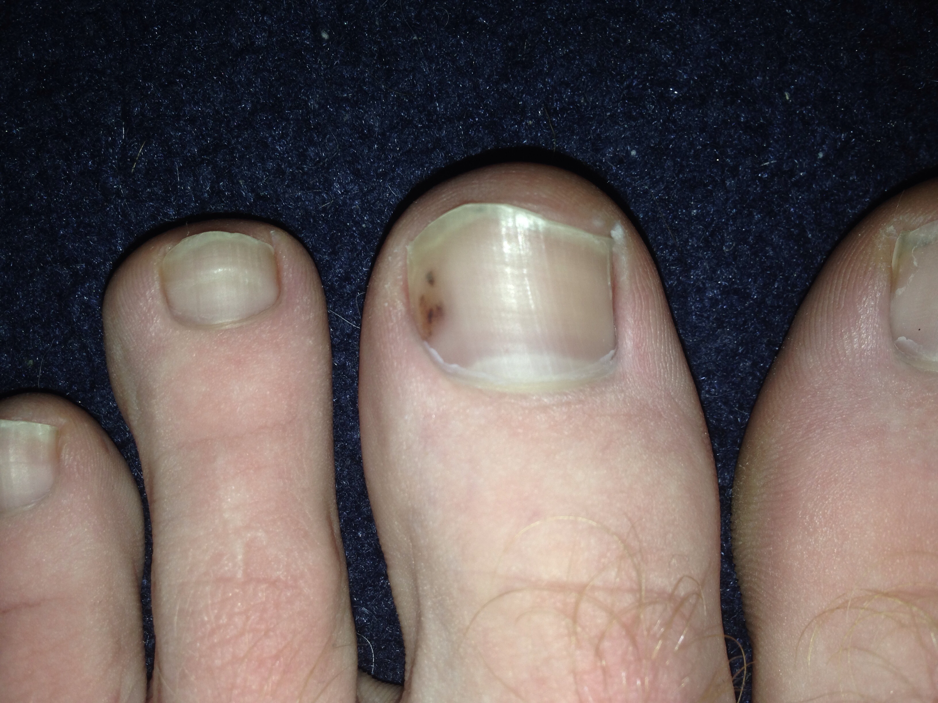 Why Is There A Brown Spot On My Big Toe