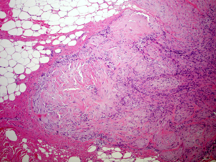 myofibroma-pictures-photos