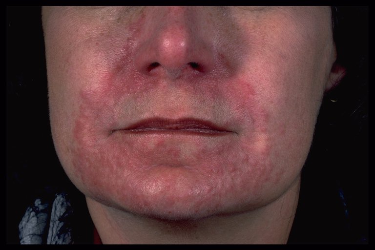 steroid induced acne - pictures, photos