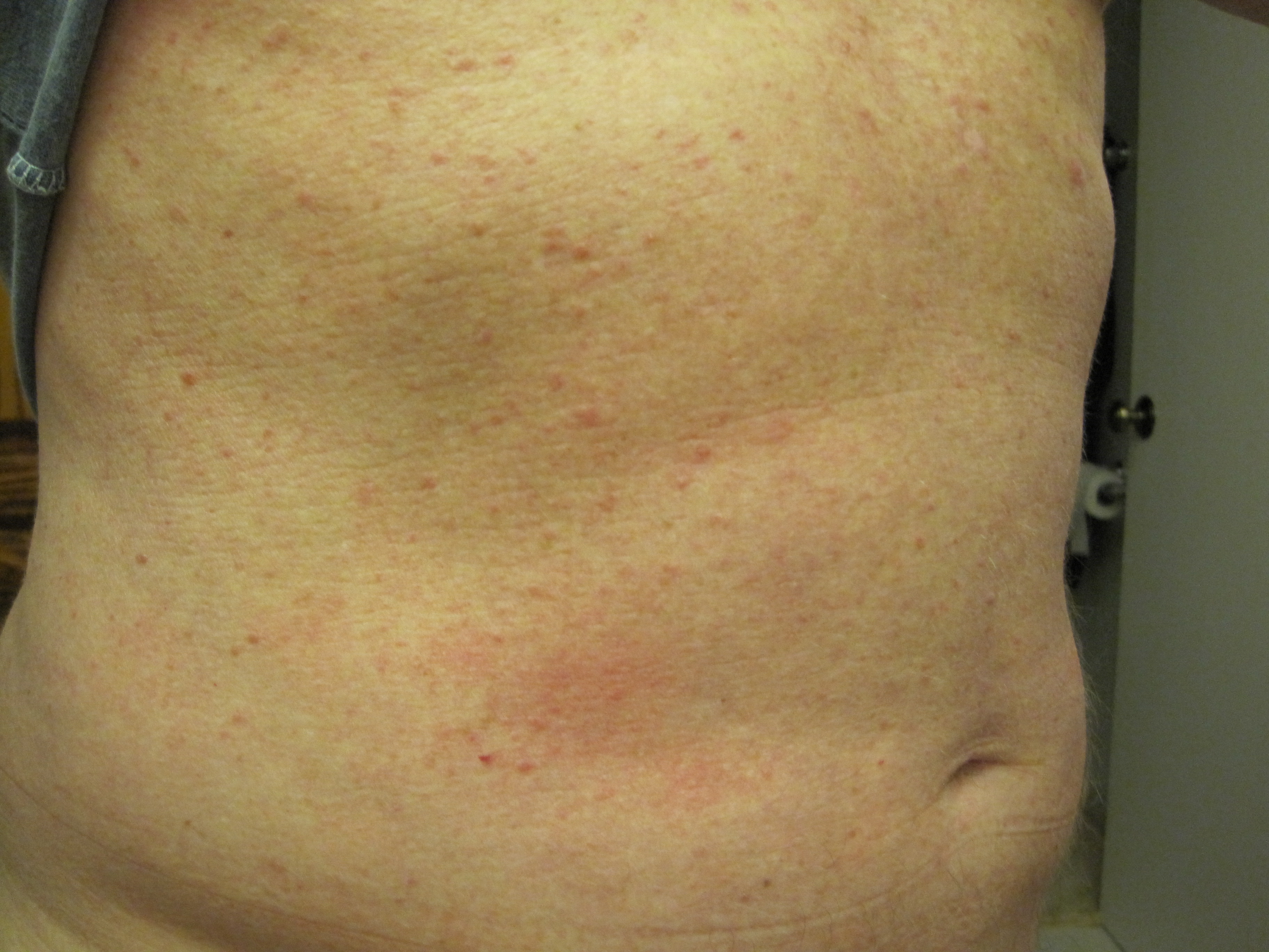 Skin Rash On Stomach