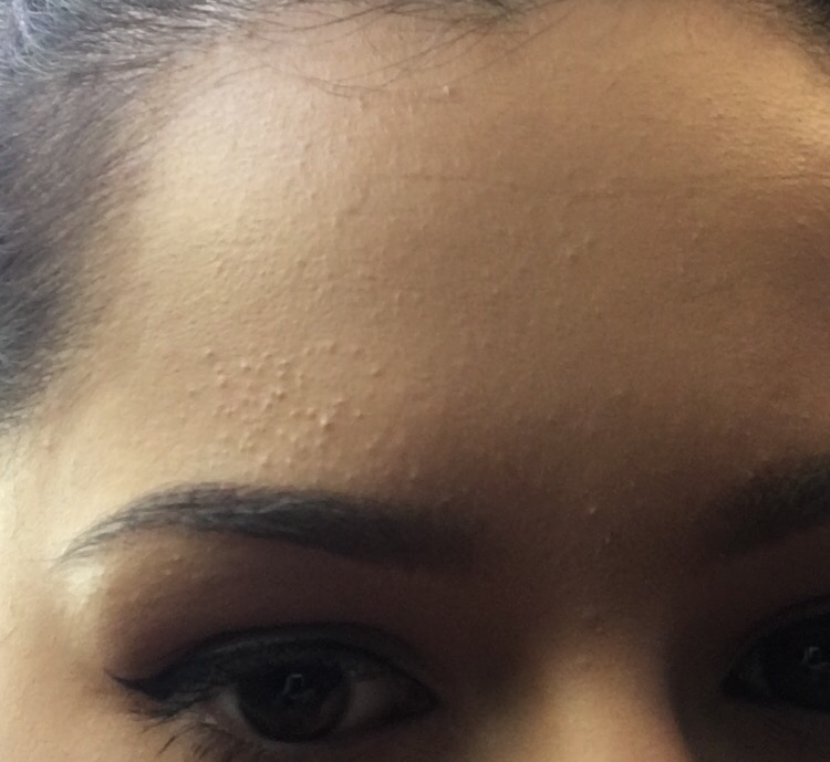 bumps-on-forehead-pictures-photos