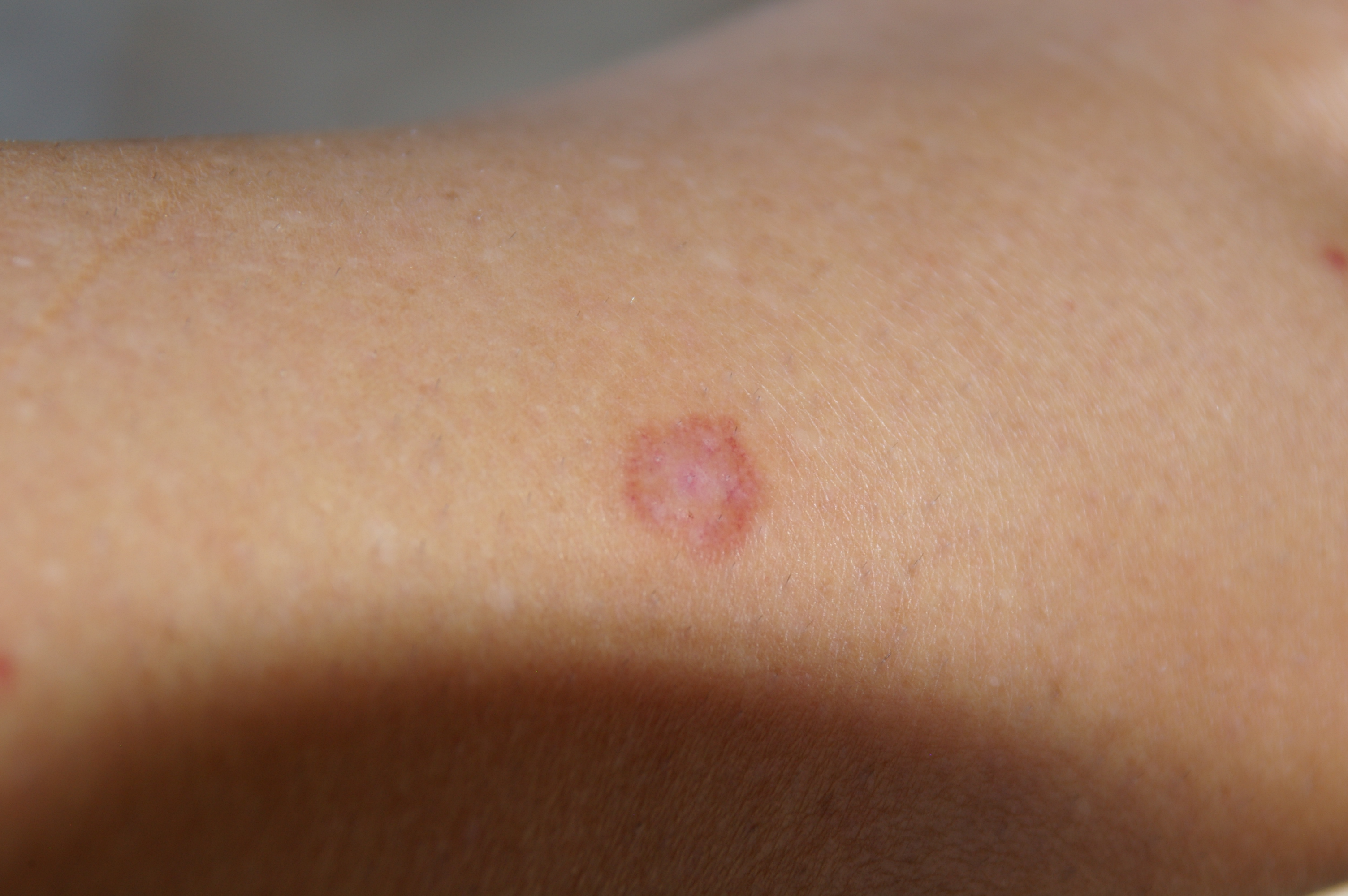 Can You Be Around People With Ringworm