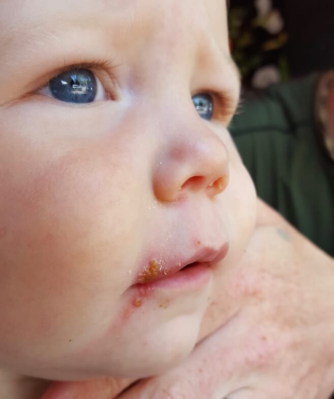 Red Spotty Rash Around Toddler S Mouth