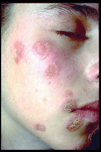 impetigo treatments - pictures, photos