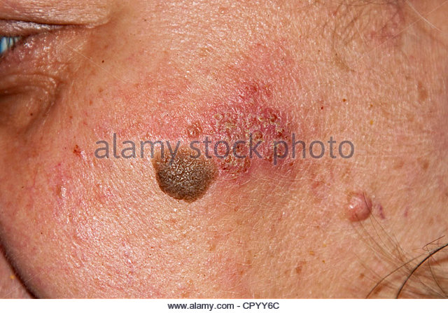 chromium allergy - pictures, photos