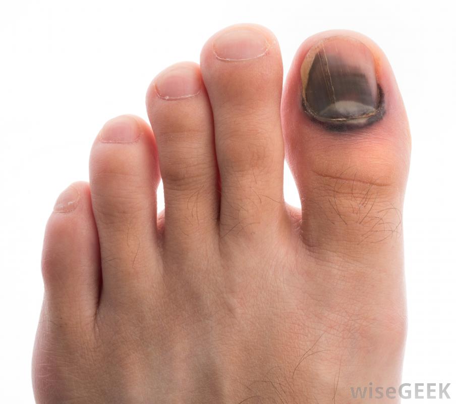 What Does Skin Cancer On A Toenail Look Like