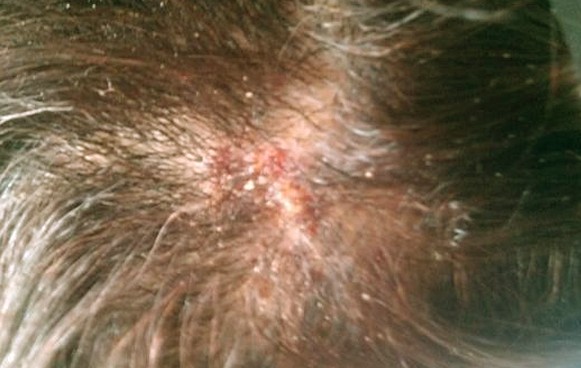 Bumps On Scalp That Itch Pictures Photos 