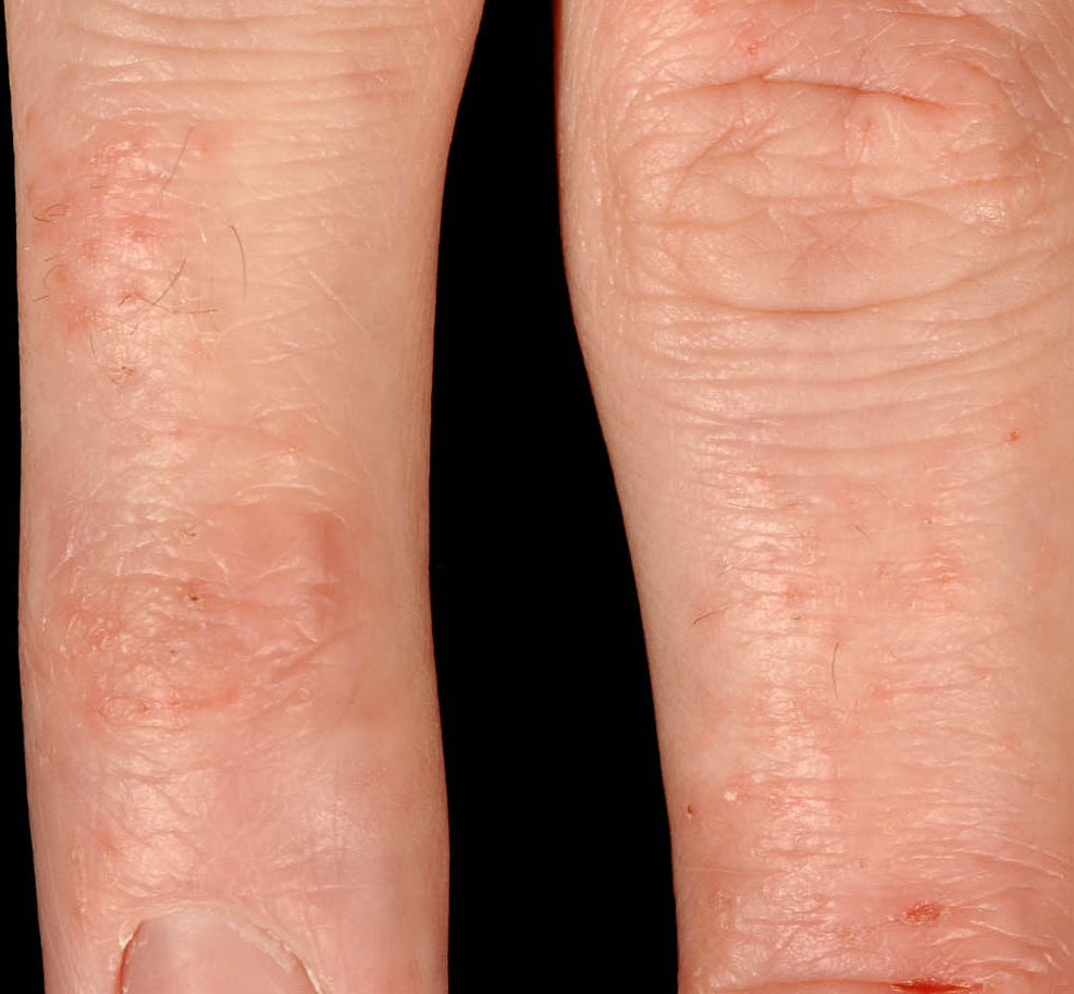 red rashes on hands pictures, photos