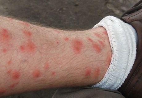 Skin Rash On Legs