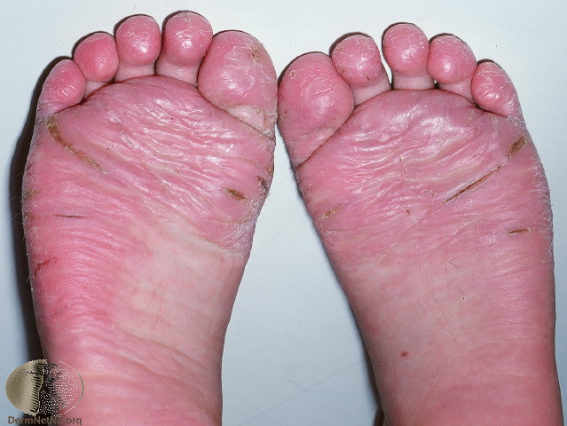 juvenile plantar dermatosis - pictures, photos