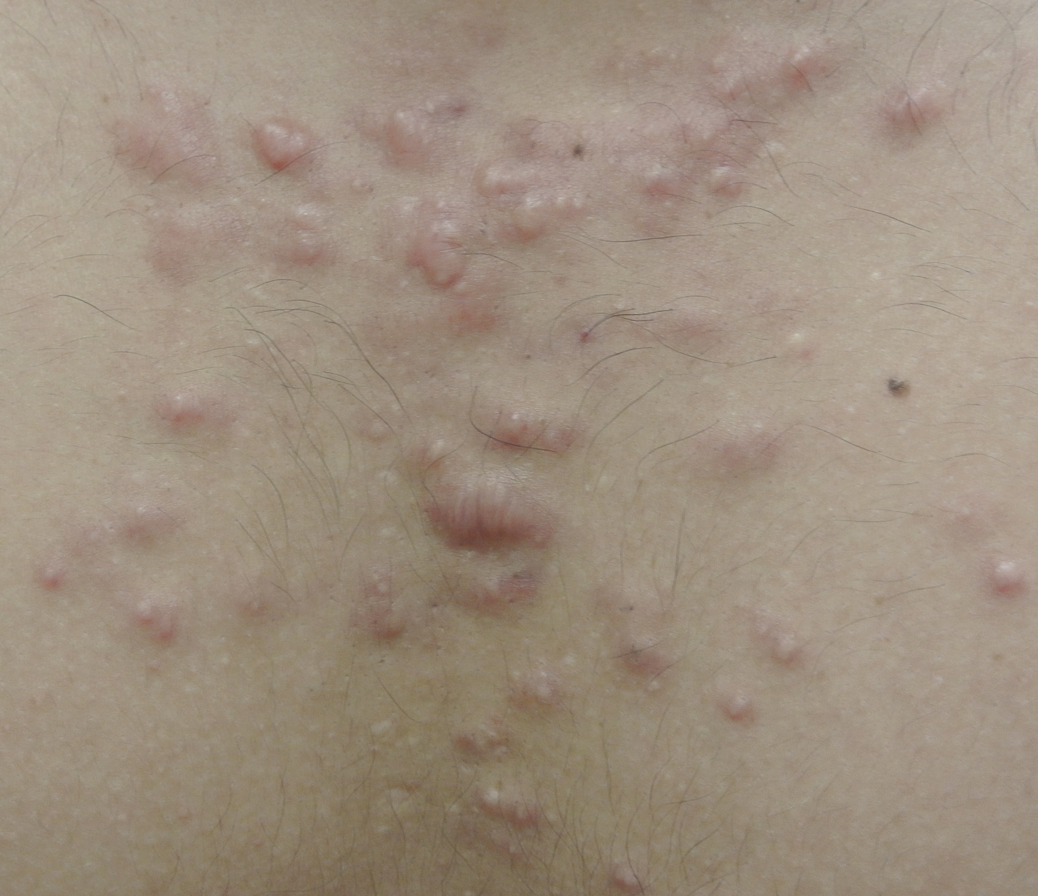 treatment on boil skin pictures,  acne keloids photos