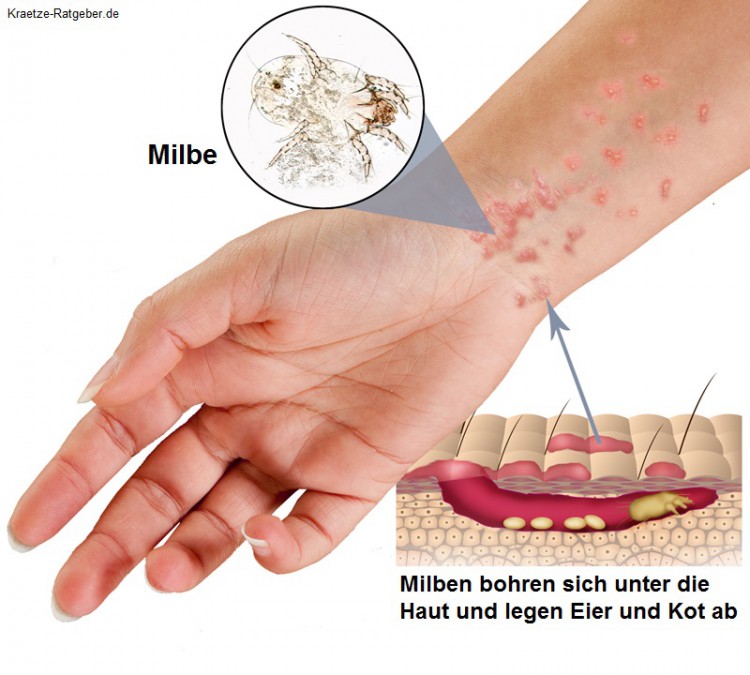 contagious skin rash - pictures, photos