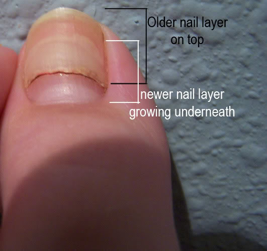 toenail-splitting-horizontally-pictures-photos