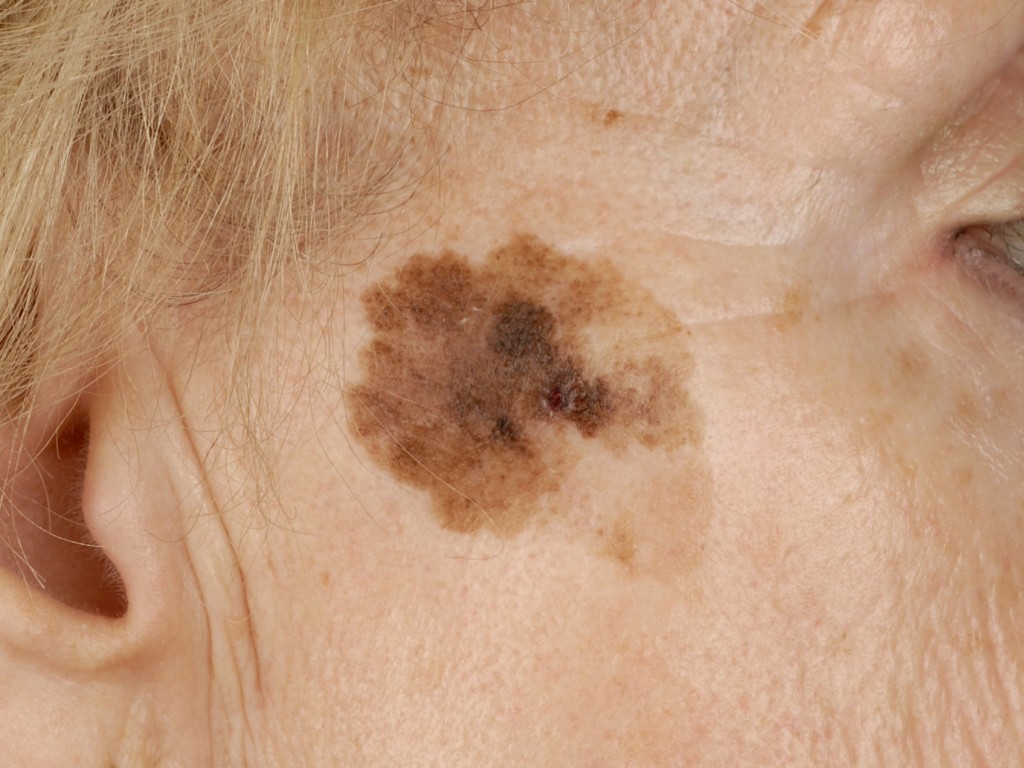 Lentigo Melanoma Pictures Photos