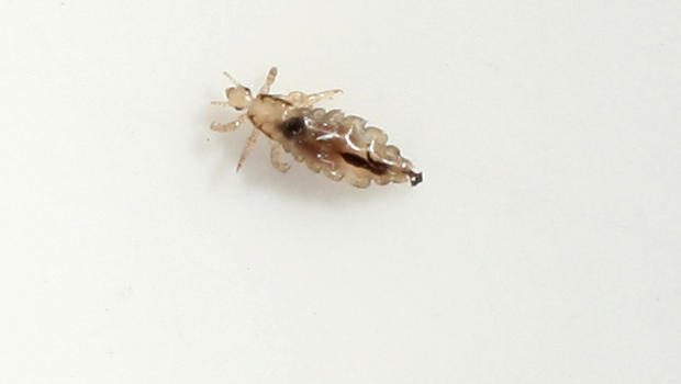 lice treatment for babies - pictures, photos