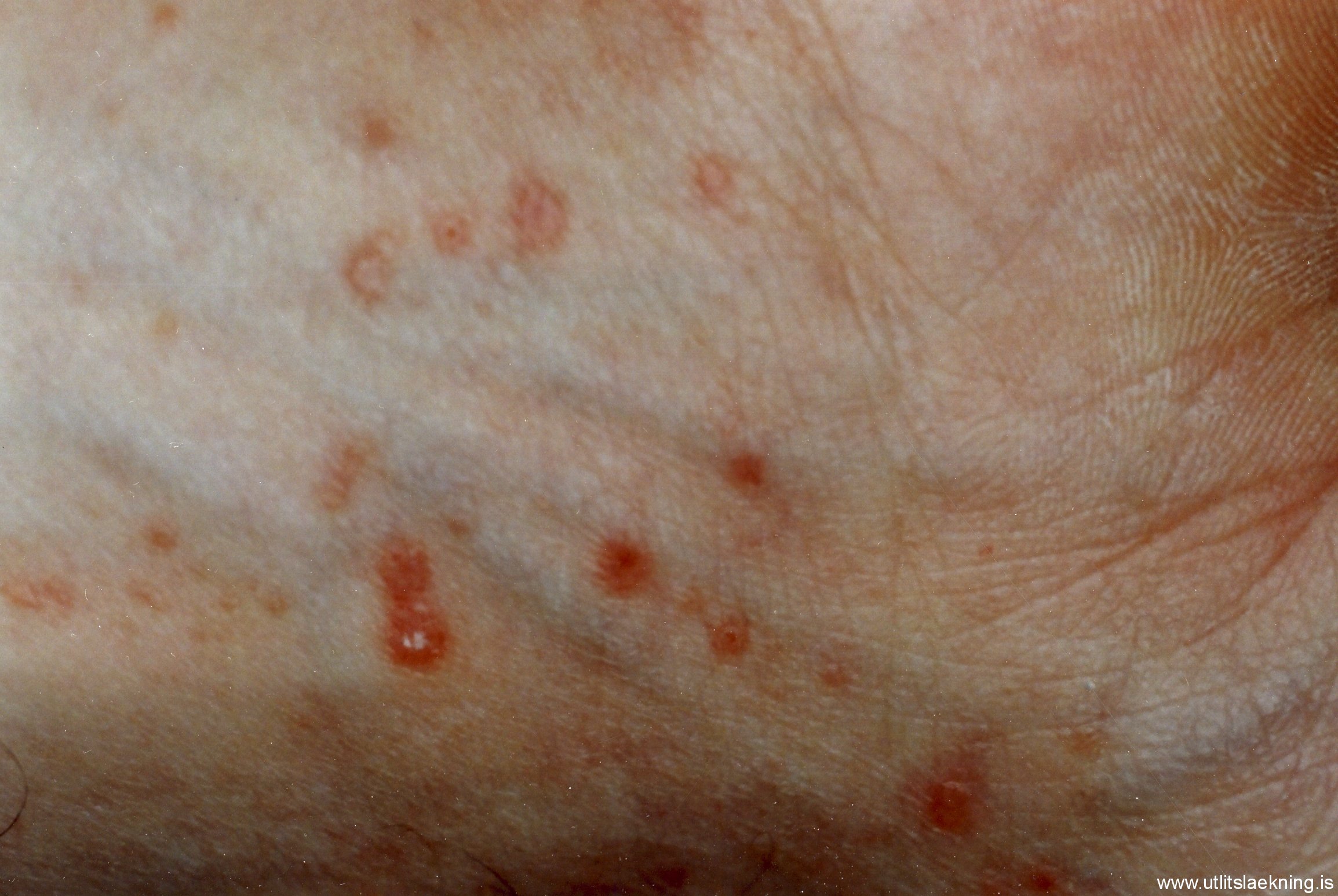 swimmers itch bumps