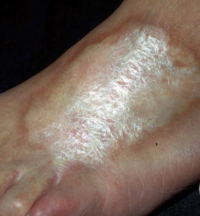 localized scleroderma - pictures, photos