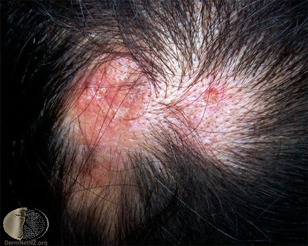 Lupus Scalp Pictures Photos